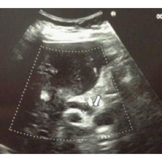 Abdominal ultrasound showing compression of the common hepatic duct ...