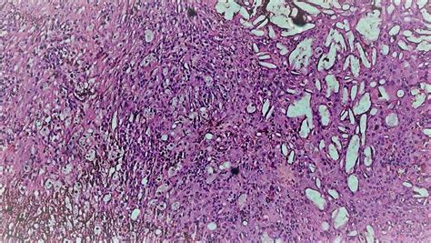 Xanthogranulomatous Inflammation Including Foamy