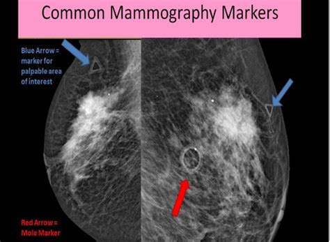 Breast Boards Us Imaging Flashcards Quizlet