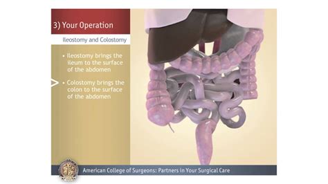 Colostomy/Ileostomy: Your Operation - YouTube