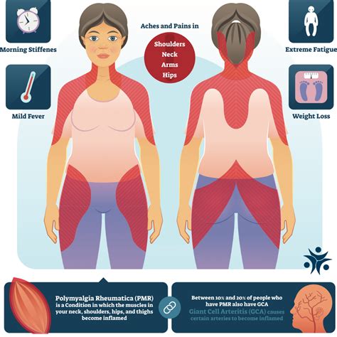 What Is The Difference Between Fibromyalgia And Polymyalgia Rheumatica