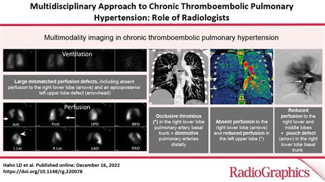 Multidisciplinary Approach To Chronic Thromboembolic Pulmonary