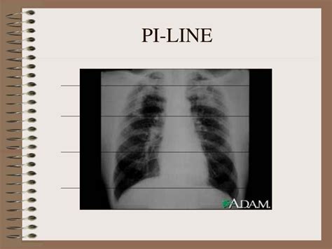 radiographic artifacts powerpoint  id