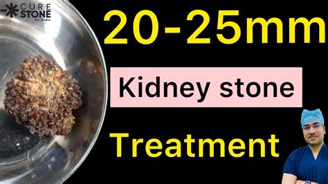 Mm Kidney Stones Mm Kidney Stones Treatment