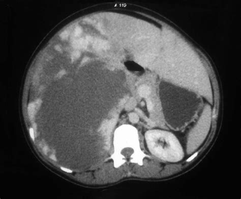 Multidetector Computed Tomography Axial Section Showing Giant