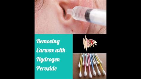 How To Loosen Ear Wax With Peroxide at Linda Rhoden blog