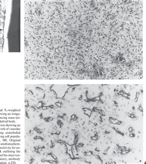 Figure 1 From Hemangioendothelioma Of The Spinal Cord With