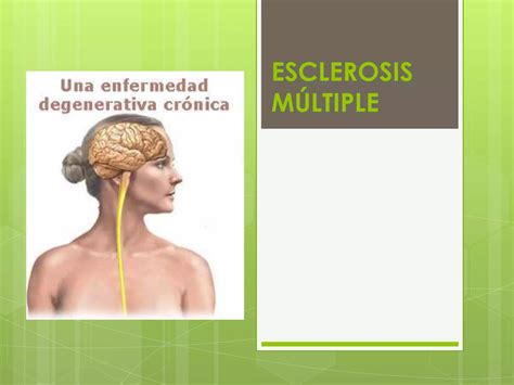 Esclerosis Multiple Ppt Descarga Gratuita