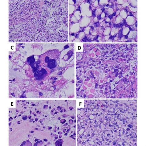 Histologic Sections Demonstrate A Pleomorphic Liposarcoma A High Grade