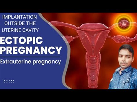 What Is Ectopic Pregnancy Ectopic Pregnancy Keya Hai Ectopic Pregnancy