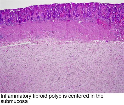 Pathology Outlines Inflammatory Fibroid Polyp