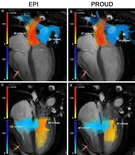 Epi And Proud D Flow Mri Streamline Visualizations Of Blood Flow