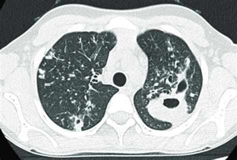 Chest CT Scan Showing One Cavitary Lesion On Right Lung And Three