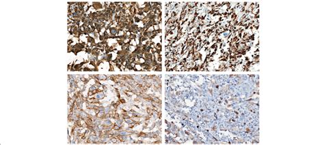 Positive Immunostaining For Vimentin A CK7 B D240 C Focal