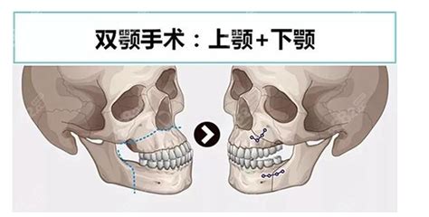 双鄂手术是正颌手术 跟凸嘴手术的区别大 比如价格差好几万 下颌角整形 8682整形网