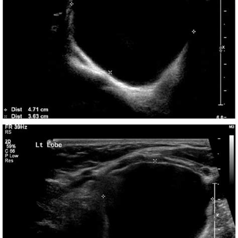 Thyroid Ultrasound Showing A Well Defined Cystic Lesion Measuring 47 × Download Scientific