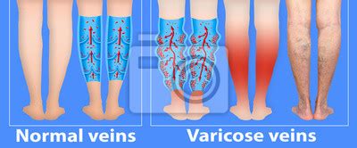 Varicose Veins On A Female Senior Legs The Structure Of Normal Posters