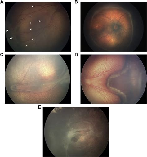 International Classification Of Retinopathy Of Prematurity Third