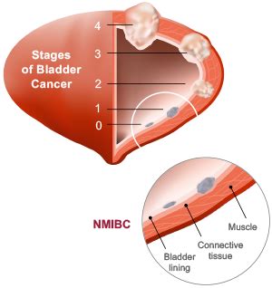 Nmibc Lipac Oncology