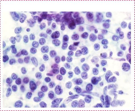 Fine Needle Aspiration Fna Cytology Of Lymphoid Lesions Definition