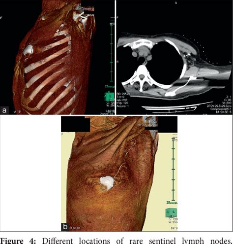 Figure 4 From Using Computed Tomography Lymphography For Mapping Of