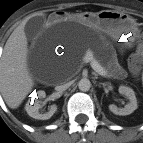 Focal Cystic Abdominal Masses In Pediatric Patients Ajr