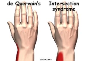 THUMB TENDONITIS | Centre For Musculoskeletal Medicine