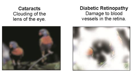 Cataract | Xpress-CataractNews | Dysphotopsia Visual Symptoms