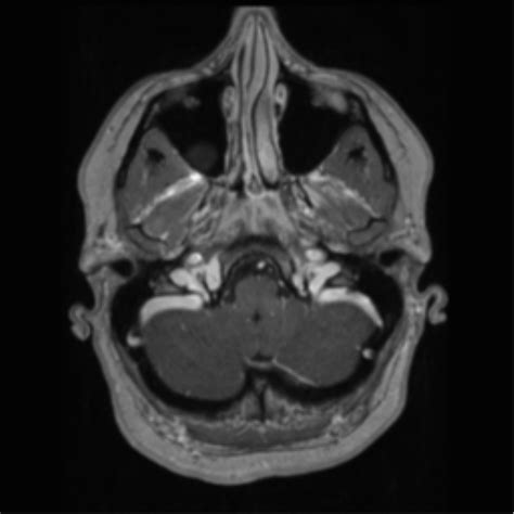 Cerebral Cavernoma And Development Venous Anomaly Radiopaedia