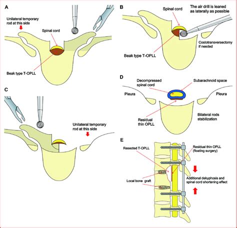 Surgical procedures in RASPA surgery (details in reference 18). A ...