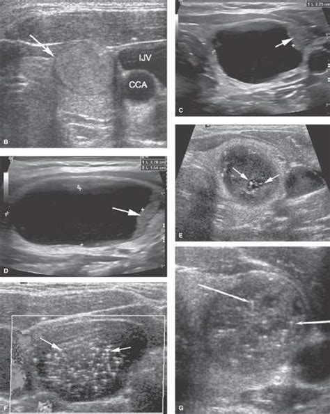 Thyroid Adenoma Ultrasound Appearance