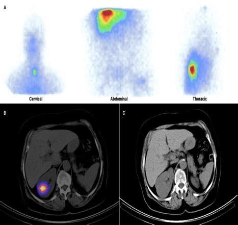 Remnant Thyroid Tissue In The Thyroid Bed Metastatic Involvement Of