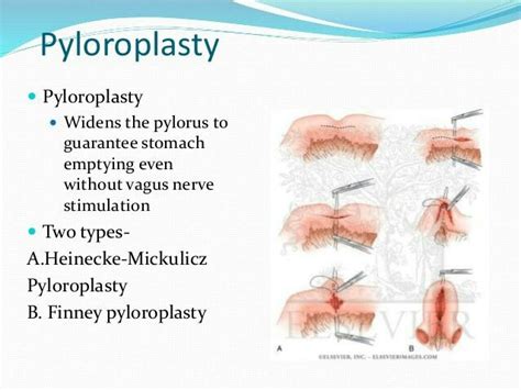 Pyloroplasty | Vagus nerve, Stimulation, Stomach