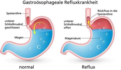 Verdauungssystem Krankheiten Gastroösophageale Refluxkrankheit