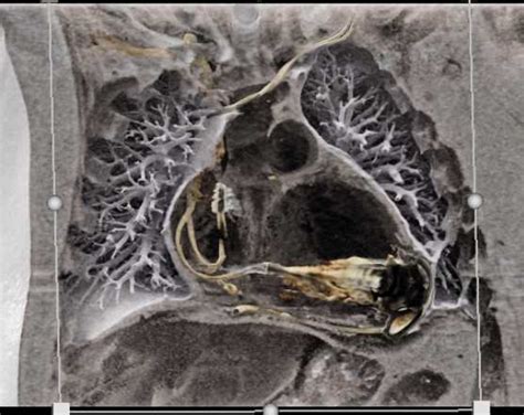 Ctisus Everything You Need To Know About Computed Tomography Ct