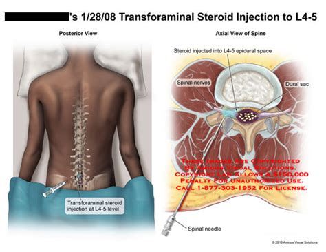 Amicus Illustration Of Amicussurgeryinjectiontransforaminalsteroidl4l5levelspine