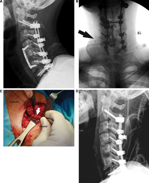 Successful Repair Of Esophageal Perforation After Anterior Cervical