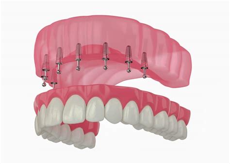 Implant Retained Dentures In Winston Salem Nc Snap In Dentures