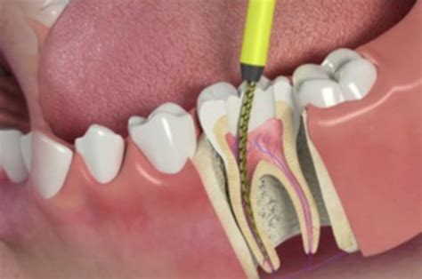 Tooth Abscess: Treatment, Symptoms, & Causes | Monroe Family Dentist