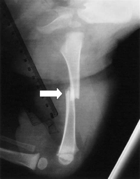 Transverse fracture. | Download Scientific Diagram