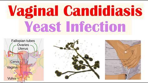 Vaginal Candidiasis Yeast Infection Causes Risk Factors Signs