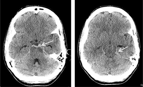 Use Of Follow Up Imaging In Isolated Perimesencephalic Subarachnoid