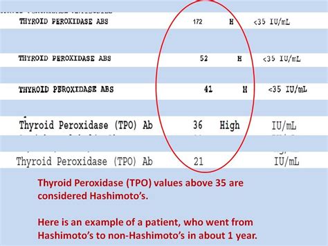 What You Must Know – How Hashimoto’s Damages Your Thyroid - Dr. Michael ...