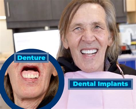 Misconceptions About Dental Implants Debunked