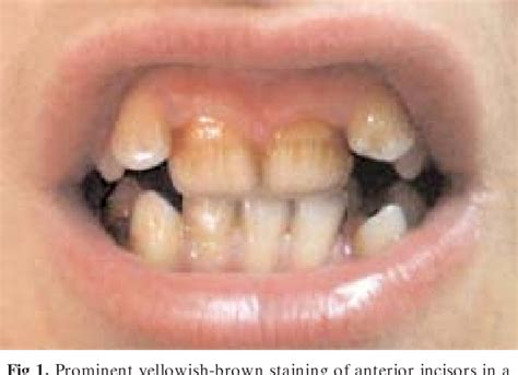 Figure From Doxycycline Induced Staining Of Permanent Adult Dentition