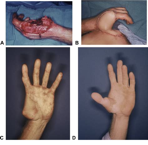 Figure 4 From Defining The Indications Of Pedicled Groin And Abdominal Flaps In Hand