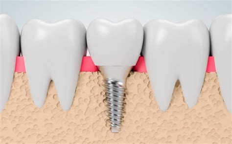 Los Implantes Dentales Para La Tercera Edad Cu Les Son Sus Beneficios