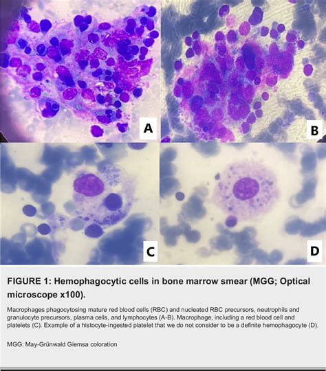 Sepsis Systemic Inflammatory Response Syndrome Sirs Sepsis Hot Sex Picture