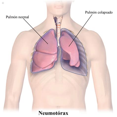 Neumot Rax Qu Es Estilo Con Salud