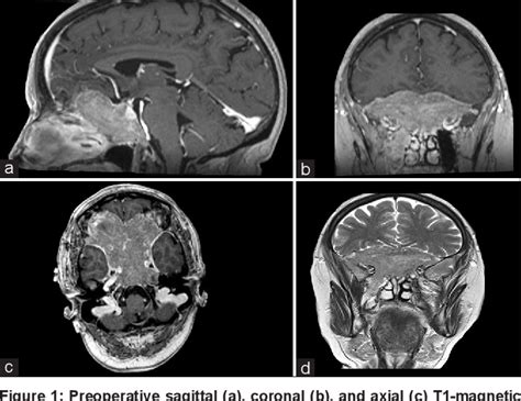 Figure From The Role Of Endoscopic Endonasal Approach In The